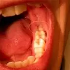 Зуб мудрости